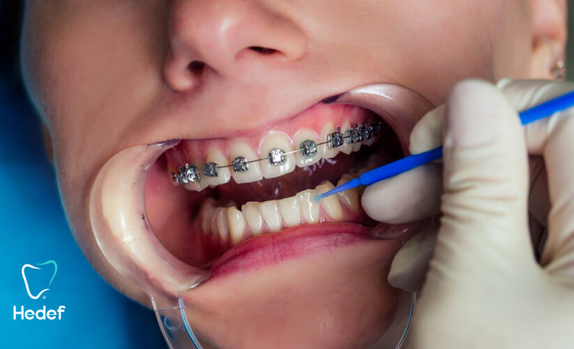 Diş Teli Tedavisi Sadece Çapraşıklık İçin mi Yapılır?