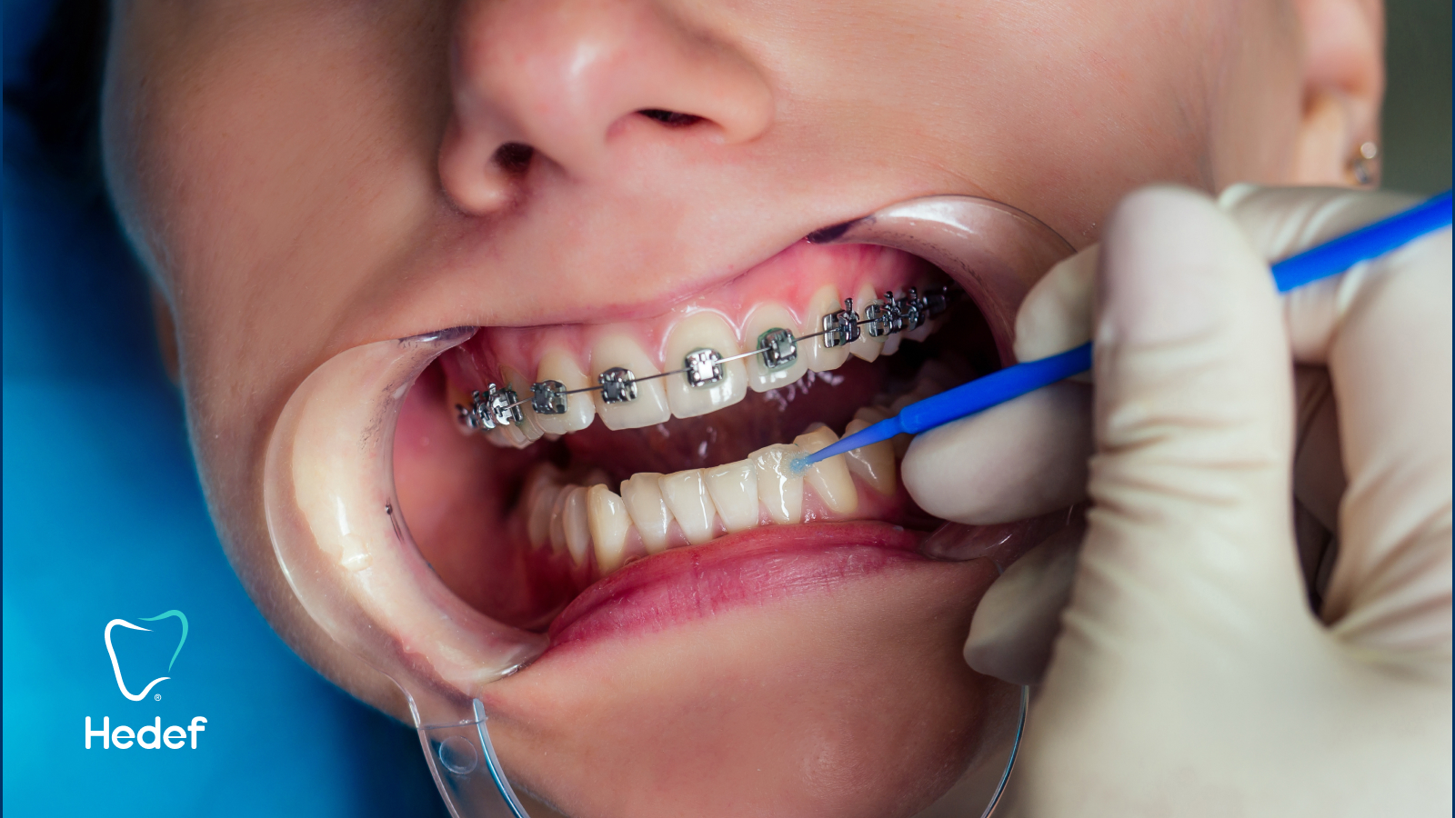 Diş Teli Tedavisi Sadece Çapraşıklık İçin mi Yapılır?