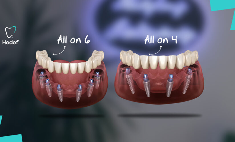 All-on-4 ve All-on-6 Arasındaki Farklar Nelerdir? Hangi İmplant Sistemi Daha Uygun?