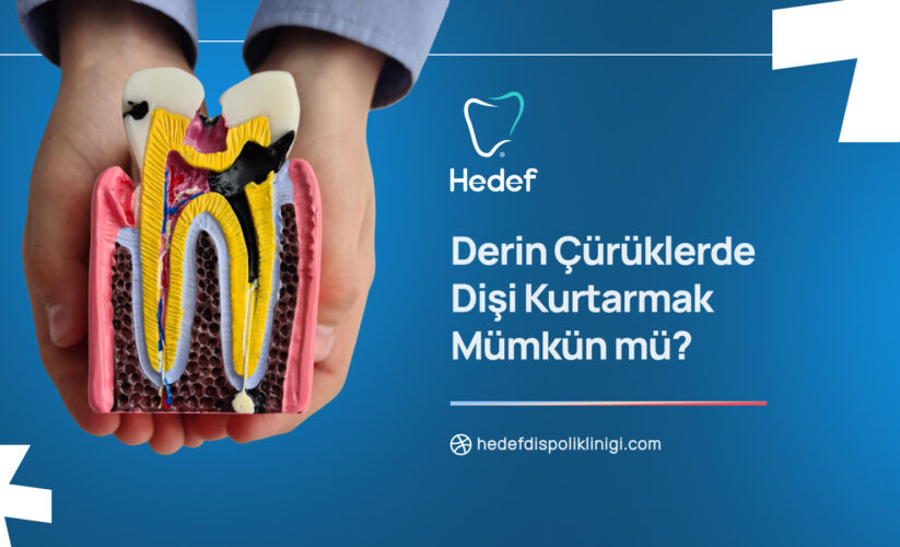 Derin Çürüklerde Dişi Kurtarmak Mümkün mü? Tedavi Seçenekleri ve Süreç