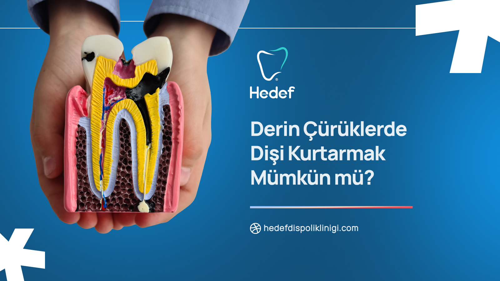 Derin Çürüklerde Dişi Kurtarmak Mümkün mü? Tedavi Seçenekleri ve Süreç