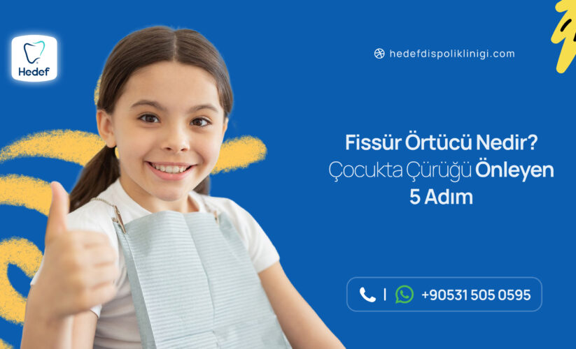 Fissür Örtücü Nedir? Çocukta Çürüğü Önleyen 5 Adım