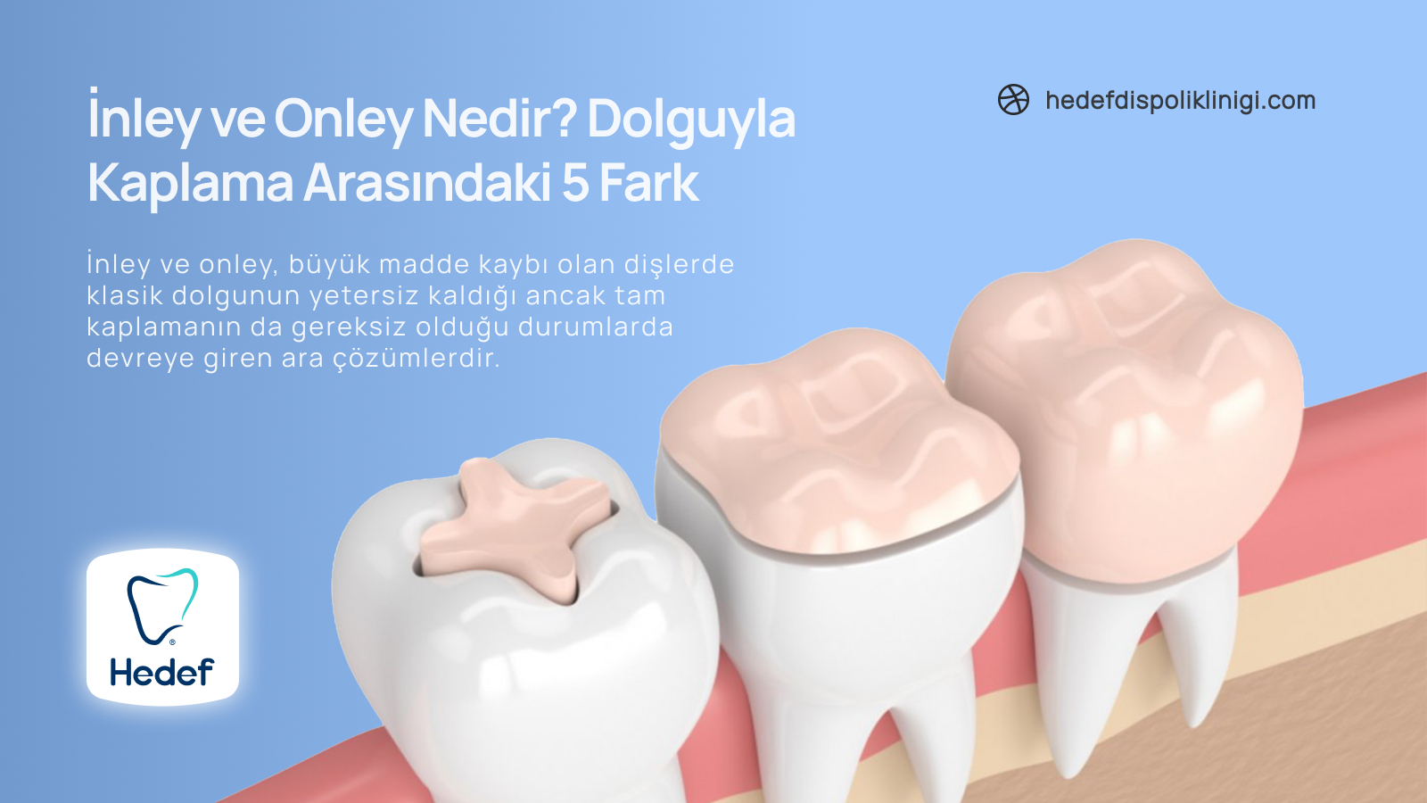 İnley ve Onley Nedir? Dolguyla Kaplama Arasındaki 5 Fark