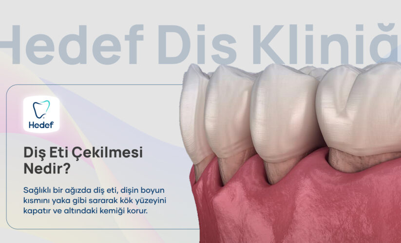 Diş Eti Çekilmesi: Nedenleri ve 7 Tedavi Seçeneği